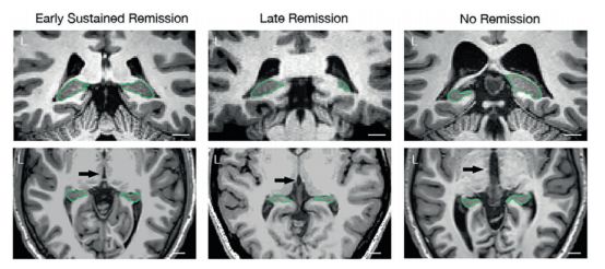 认知疗法治疗抑郁症的策略,抑郁症最新研究资讯