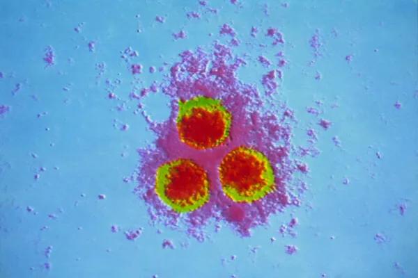 如何缓解水痘发热症状,水痘初期症状会和感冒一样吗