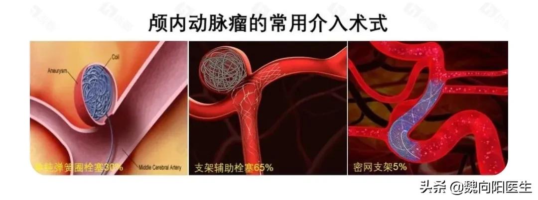 颅内动脉瘤做开颅还是介入好,颅内动脉瘤是介入好还是开颅好