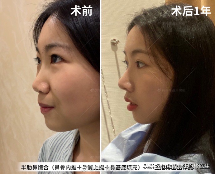 那些被鼻子“封印”颜值的鼻综合/修复案例|广州鼻整形