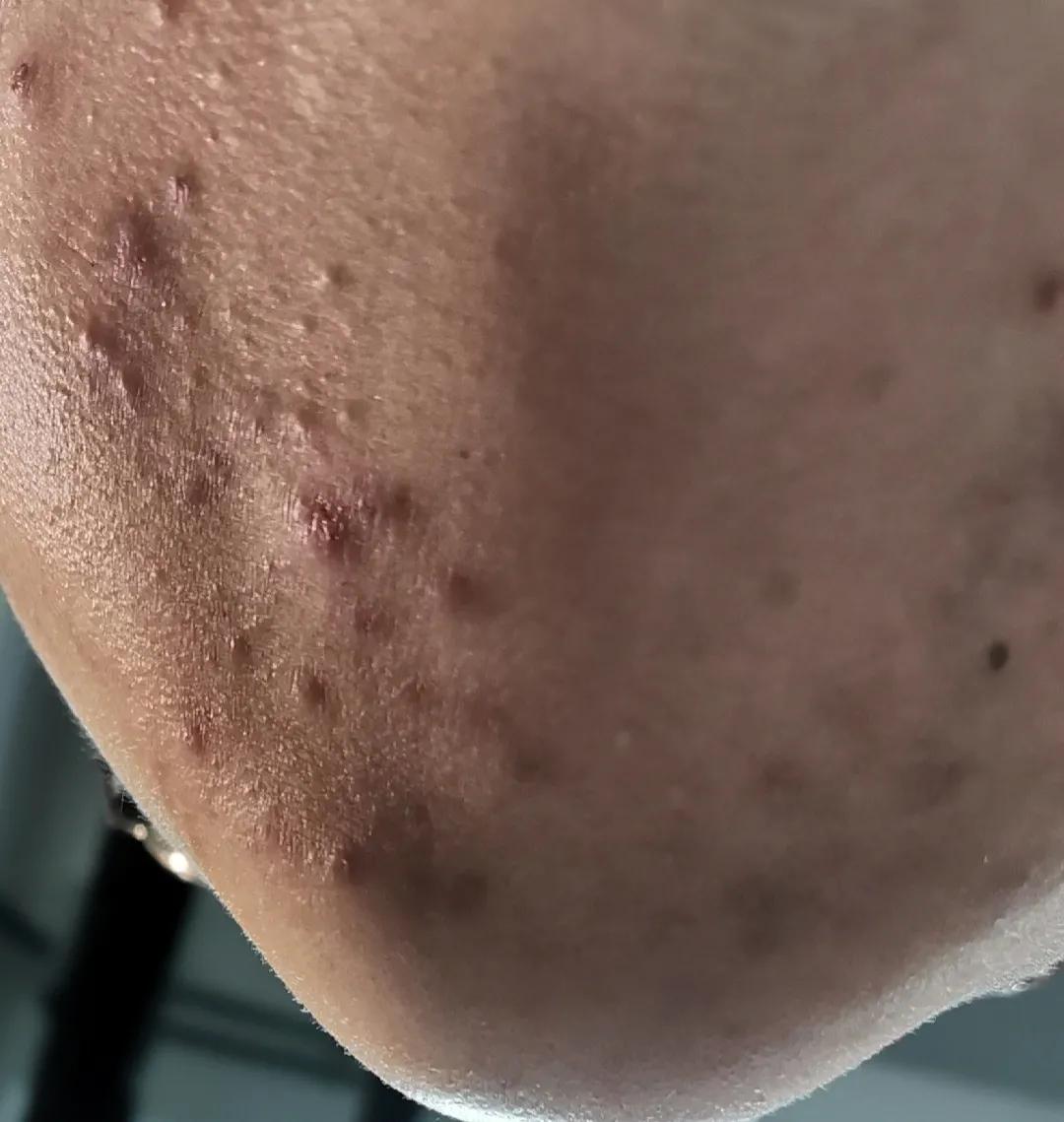 吐血总结祛痘膏,反反复复爆痘怎么都不管用