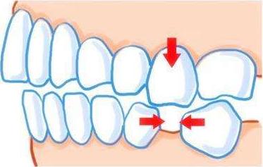 牙科的良心忠告,牙医的良心忠告牙齿矫正