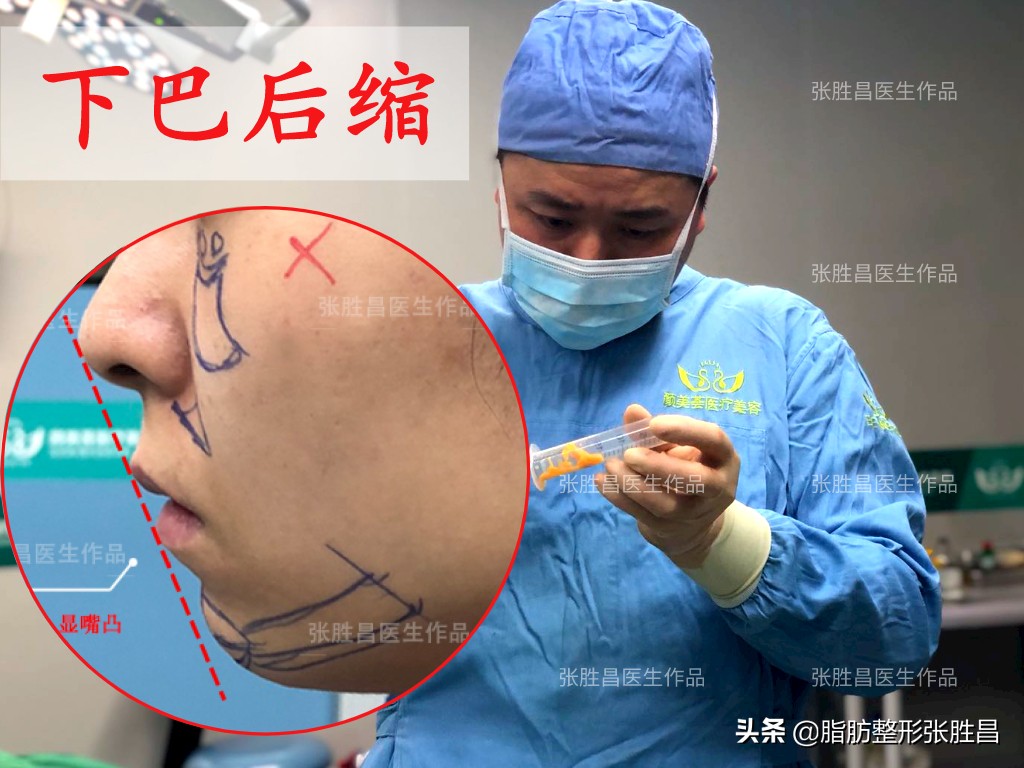 做完假体还能填脂肪吗,做完假体下巴还能打玻尿酸吗