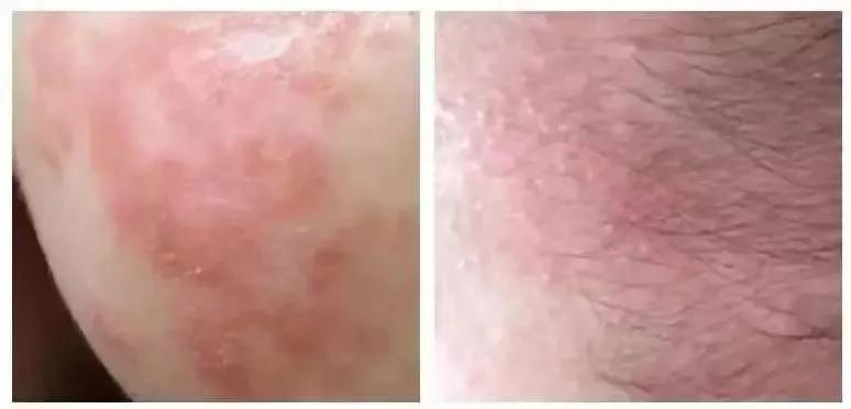 小孩身上起疙瘩总是挠,孩子身上过敏起痱子一样的疙瘩