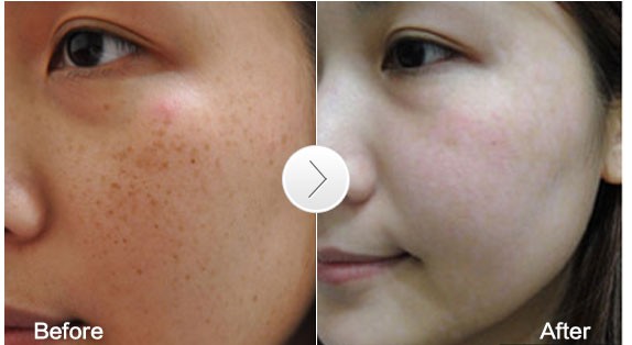 脸上长斑是激光还是用祛斑产品好,50岁年龄脸上长斑怎样能祛斑