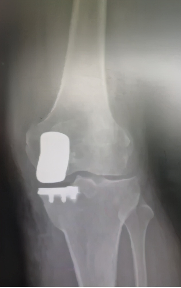 膝关节痛风肿胀疼痛怎么办,膝关节肿胀是痛风吗