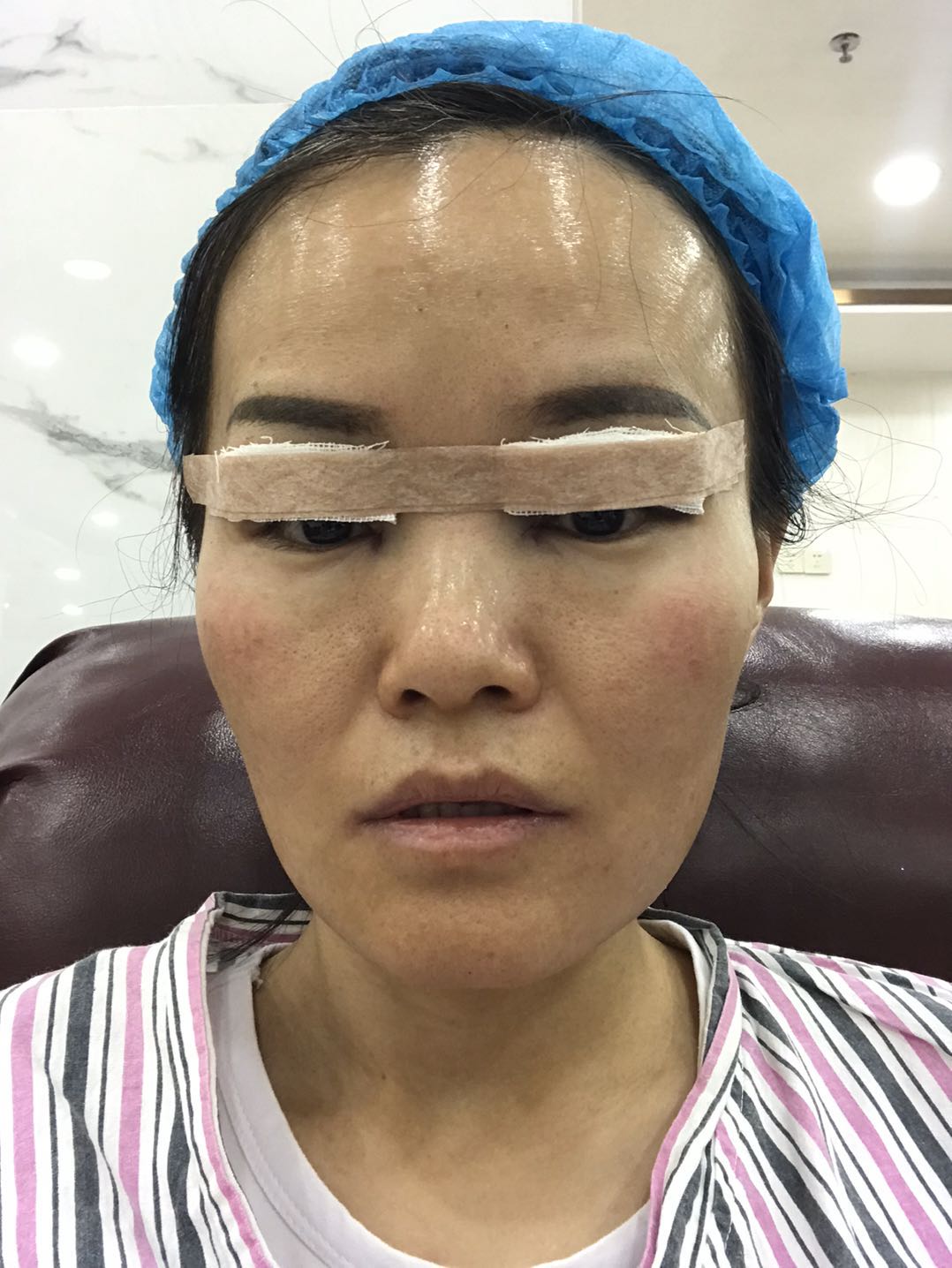 眼球突出割双眼皮好看吗,割双眼皮的危害