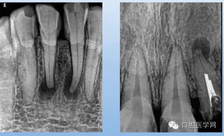 根尖周炎能自愈吗,根尖周炎x光图片