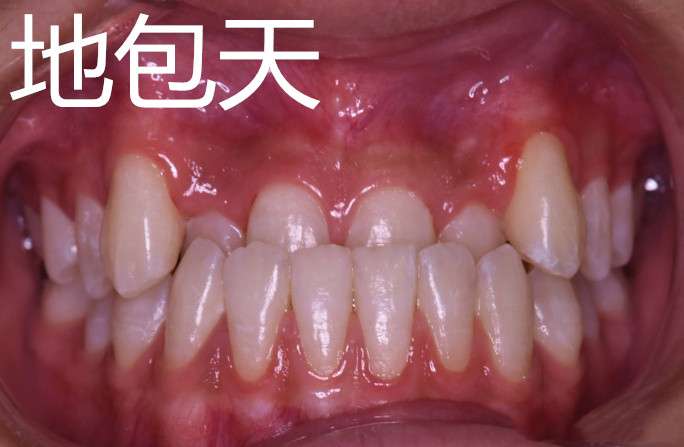 30岁了还可以做牙齿矫正吗,30岁还可以做牙齿矫正吗