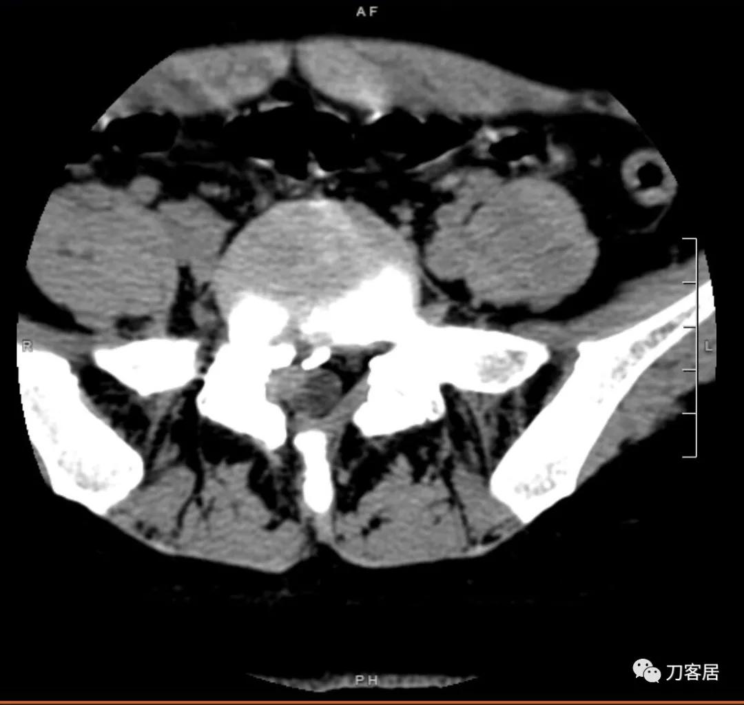 椎间孔镜微创手术13天,椎间孔镜微创手术患者