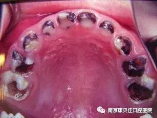 预防儿童蛀牙可打针预防吗,预防蛀牙可做窝沟封闭