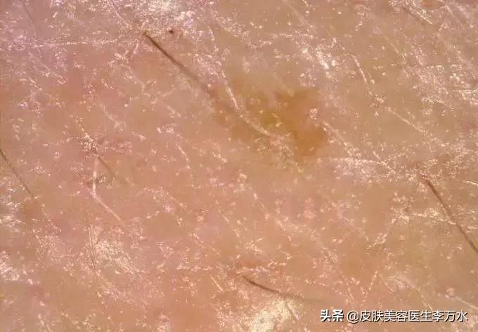 大油皮的坏处是什么,大油皮为啥还起皮