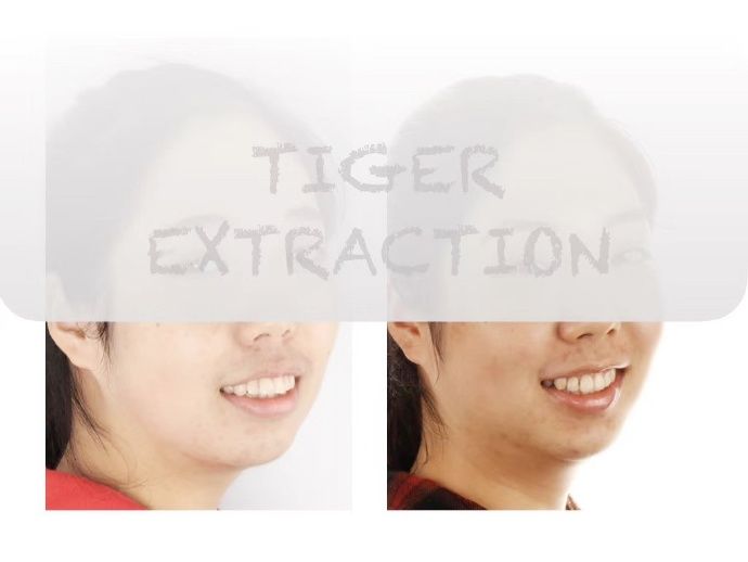 牙齿矫正南京哪家医院比较好,牙齿代偿性矫正