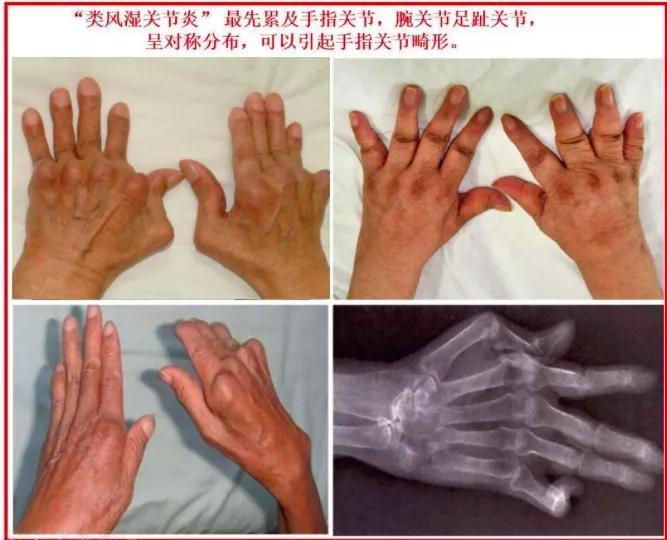 免疫治疗不良反应及处理方法,免疫治疗不良反应的处理