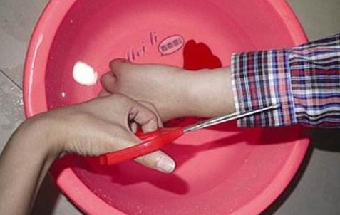 孩子严重烫伤9天才被家长送医,儿童烫伤最佳处理时间只有两分钟