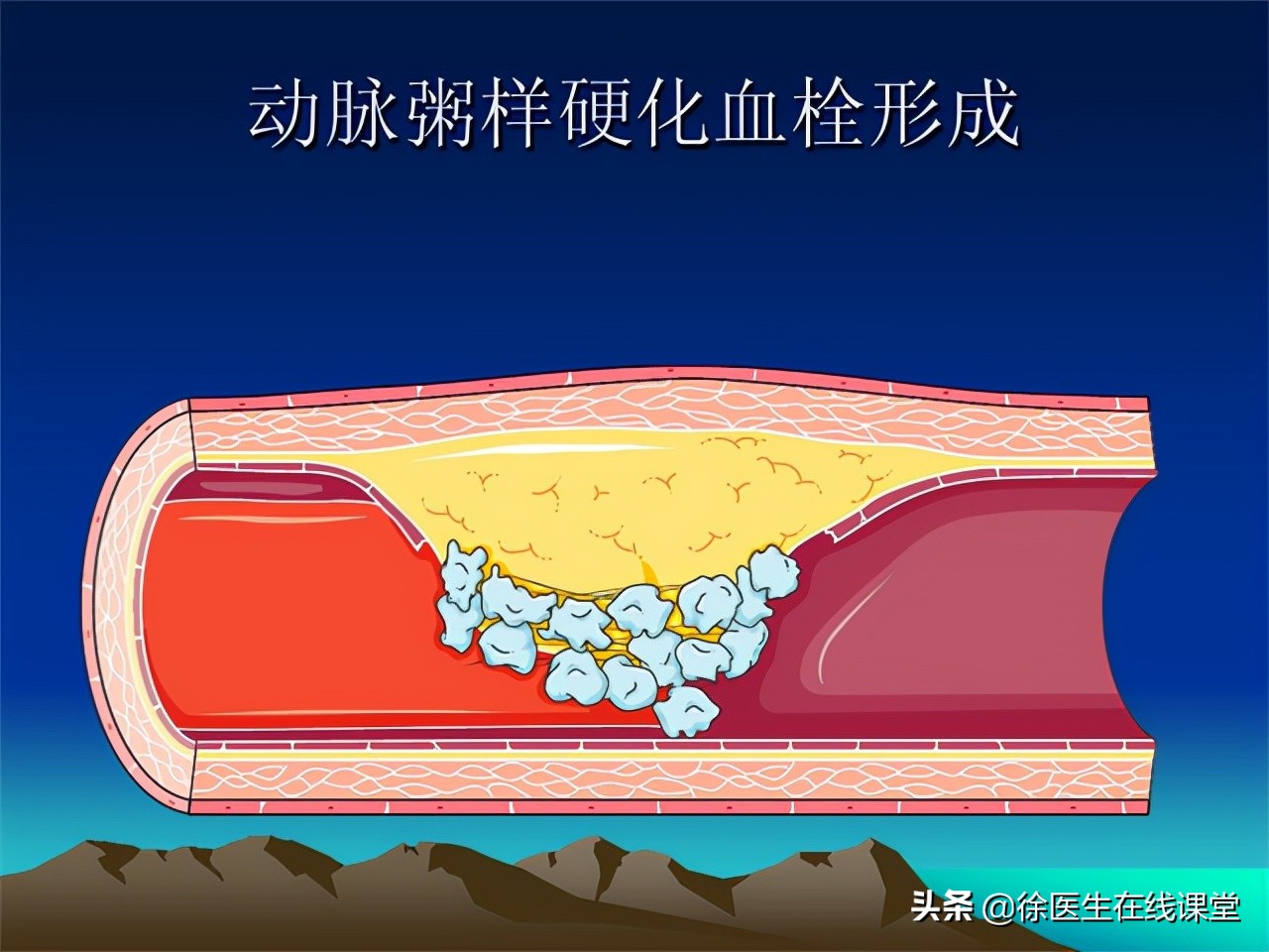 血粘度高吃脂必妥管用吗,血粘度偏高吃阿司匹林吃多久停药