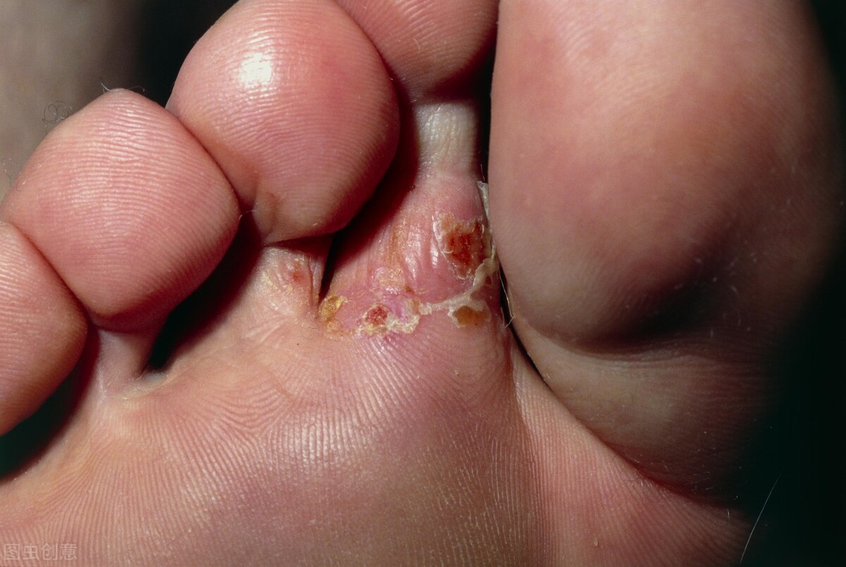 脚气足癣怎么治疗,脚气足癣能治愈吗