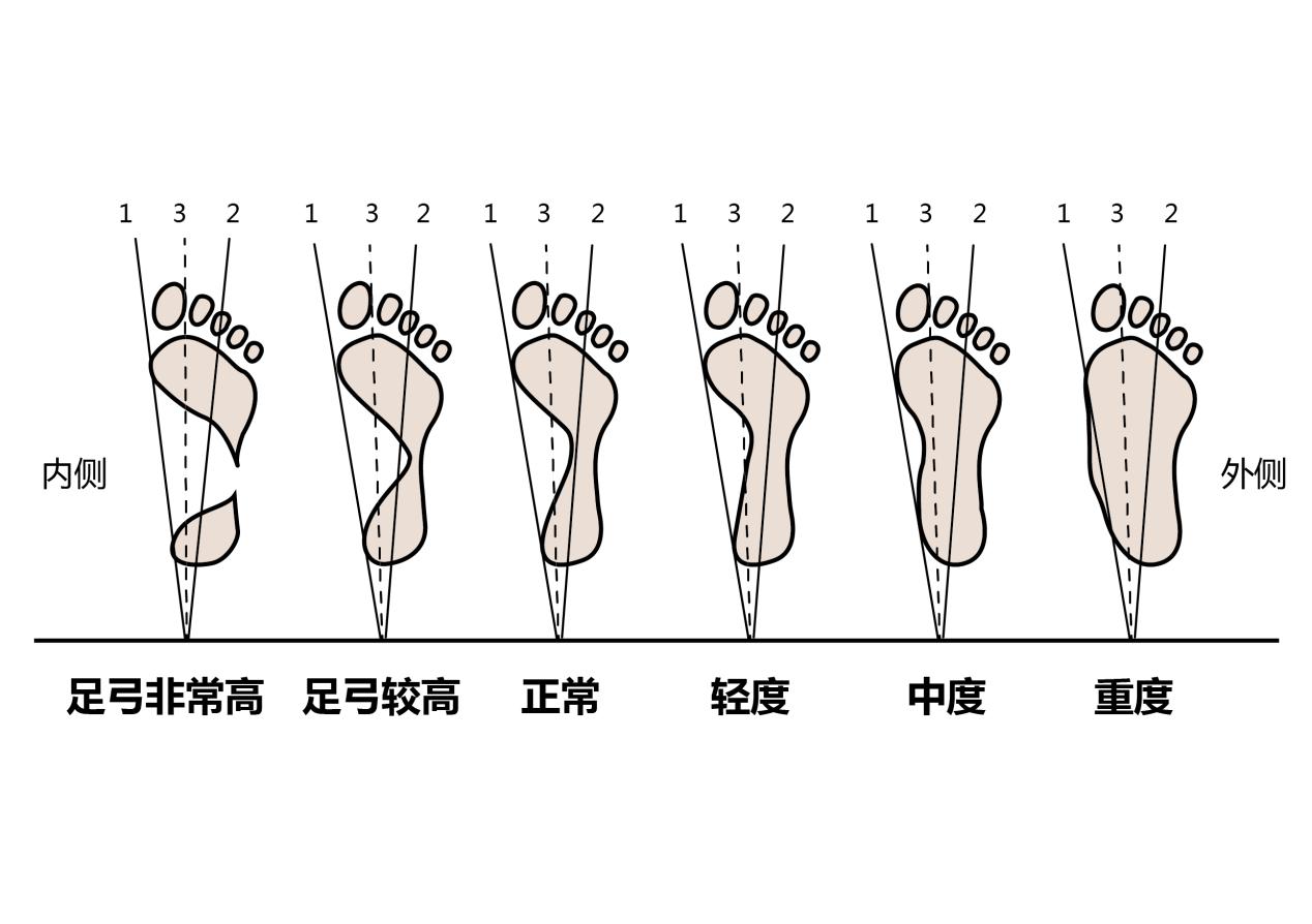 足弓高会造成脚后跟疼吗如何治疗,脚后跟疼是因为足弓高还是足弓低