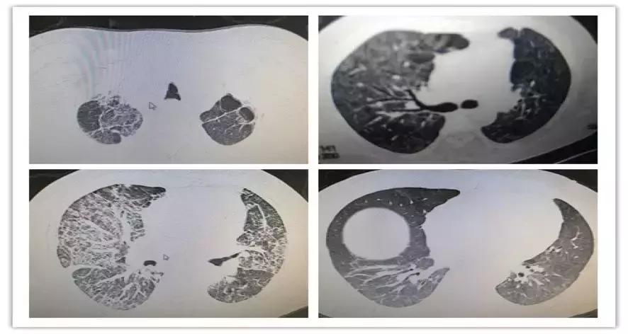 罕见病误诊的真实案例,误诊漏诊导致病人肿瘤癌变