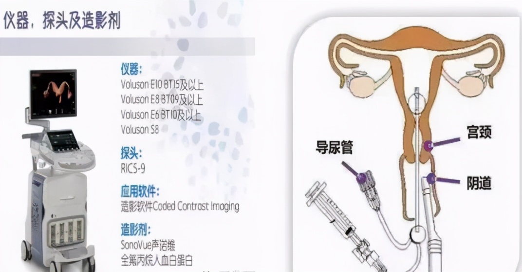 四维子宫输卵管超声造影术,子宫输卵管三维超声造影检查过程