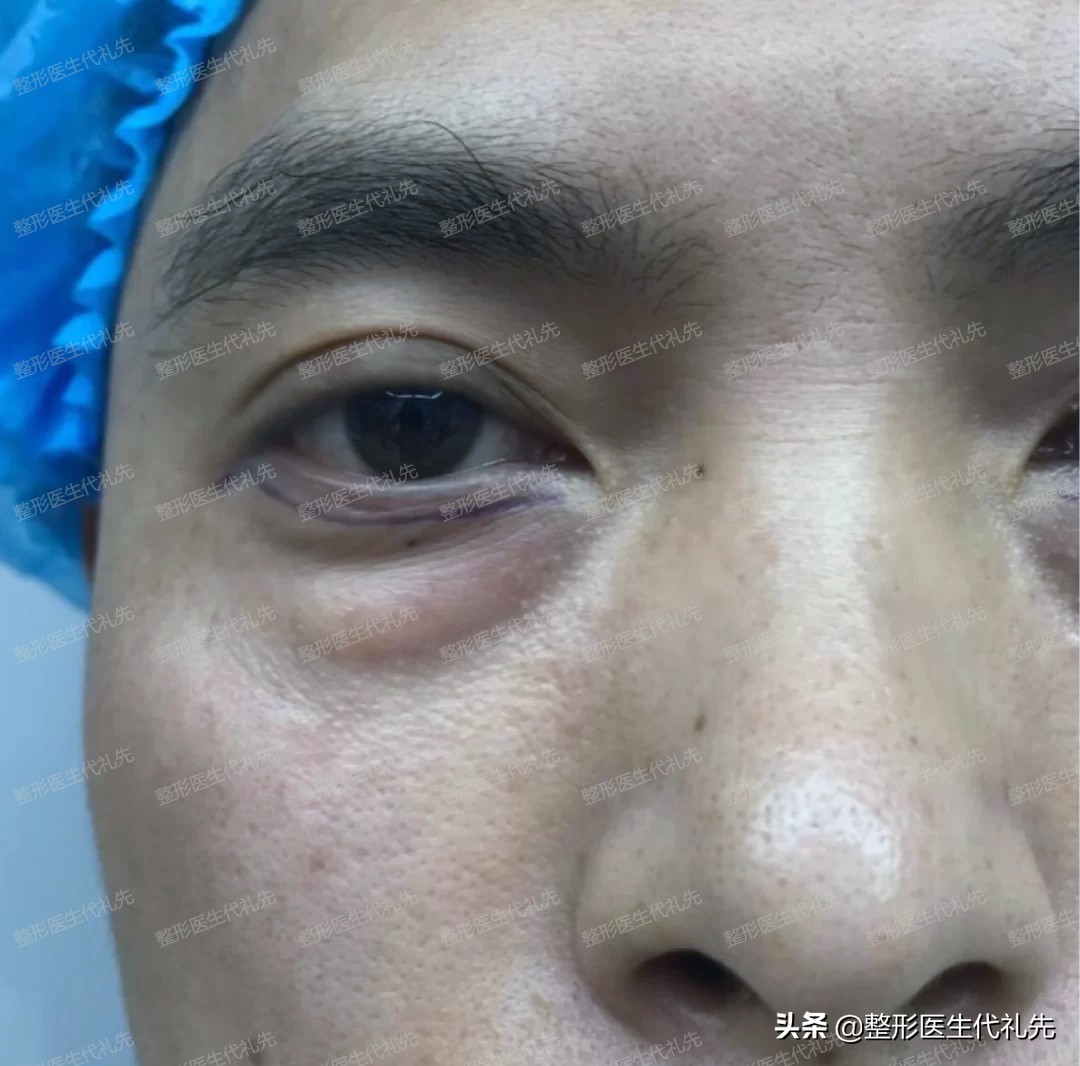 眼周年轻化手术图片,眼周年轻化什么项目