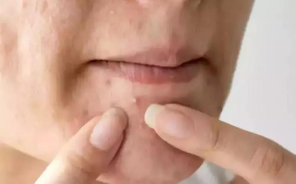 琼海准大学生网上“治”痘痘，8600元学费被忽悠，想退款遭威胁…