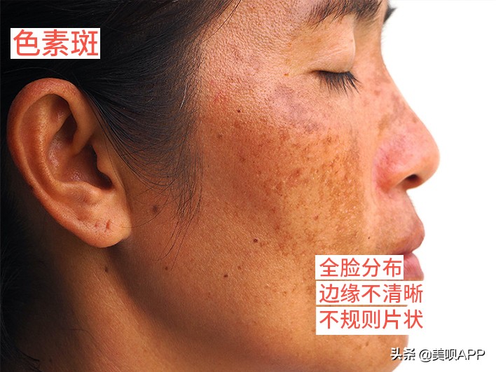 脸上有斑怎么祛斑最快最有效,脸上长斑点用什么药才能祛斑