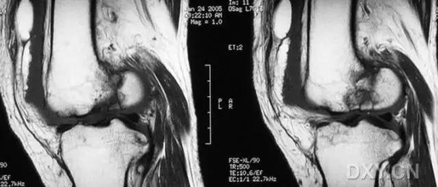 特殊骨折类型,特殊骨折体征