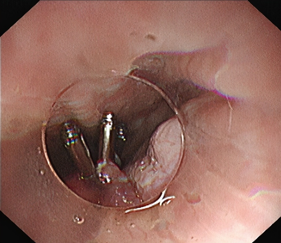 内镜下贲门失弛缓症微创手术,贲门失弛缓内镜治疗