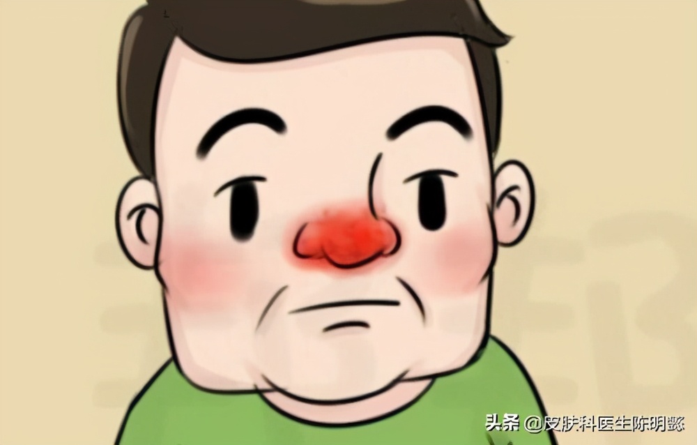 玫瑰痤疮别名酒糟鼻怎么治疗,玫瑰痤疮酒糟鼻怎么治啊