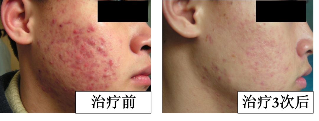 中医火针疗法教学视频,火针操作手法