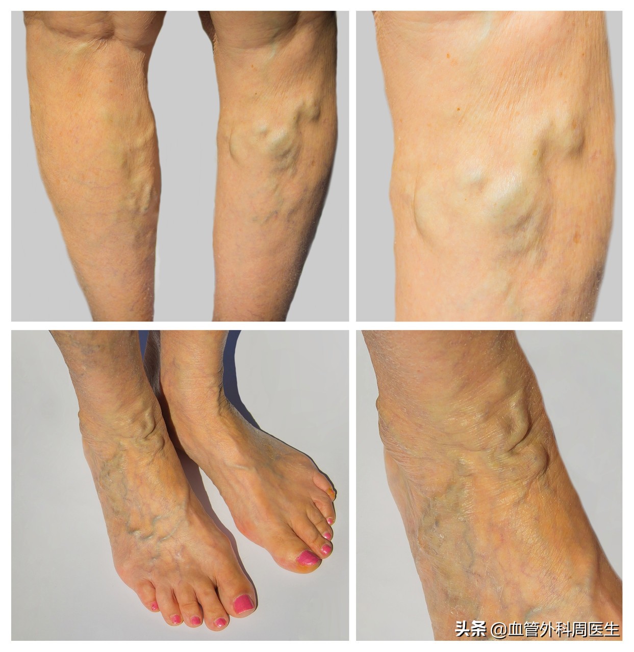 为什么很年轻就会得下肢静脉曲张,关于下肢静脉曲张那些事