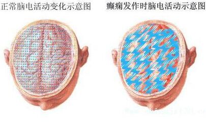 癫痫儿童饮食要注意什么,儿童癫痫饮食上需要注意什么