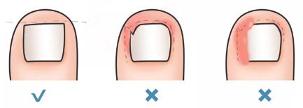 指甲长肉里导致脚发炎,指甲长到肉里甲沟炎