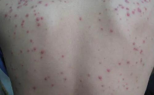 得了乙肝的人身上长红点怎么回事,乙肝病毒携带者身上有一颗颗红点