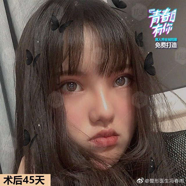 双眼皮做完有肉条怎么办,做完双眼皮肉条很难看