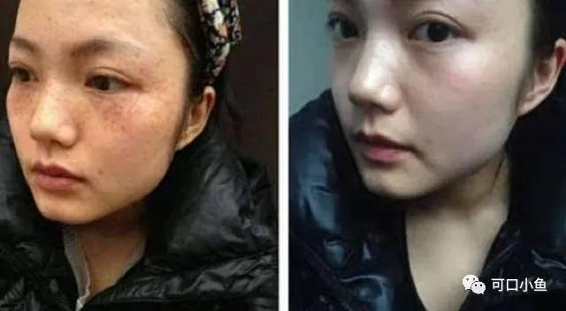 红霉素软膏用对了，居然可以祛斑，难怪有人一直在用呢