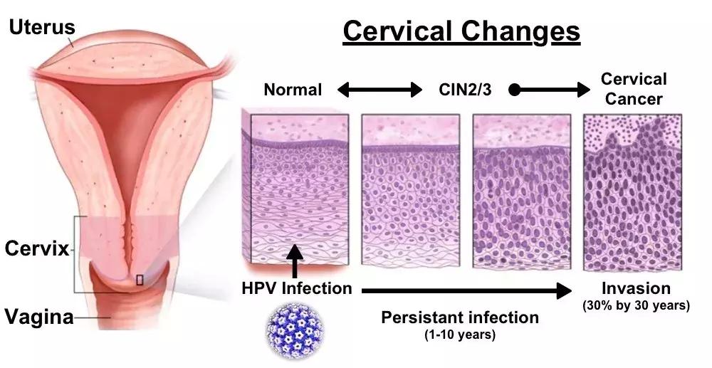 宫颈涂片能够有效筛查宫颈癌吗,宫颈癌筛查冲洗