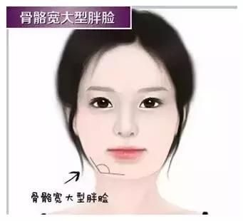 解密瘦脸针的几大常识性问题,关于瘦脸针的真实事件