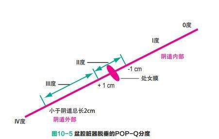 产后子宫脱垂能通过盆底肌修复,产后尿潴留的预防