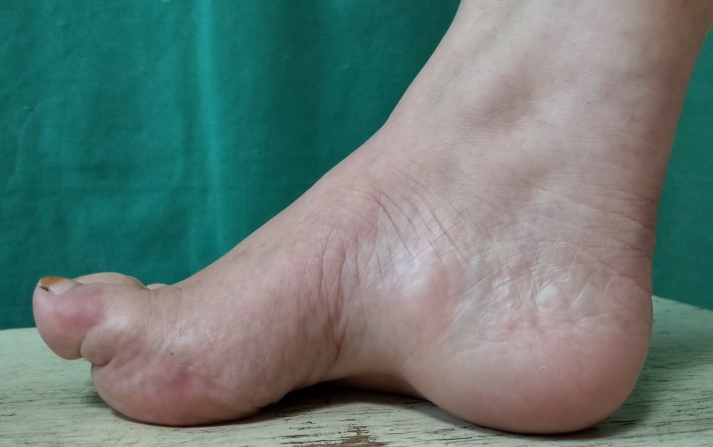 足内翻和踮脚走怎么康复,足内翻会导致什么腿型怎么改