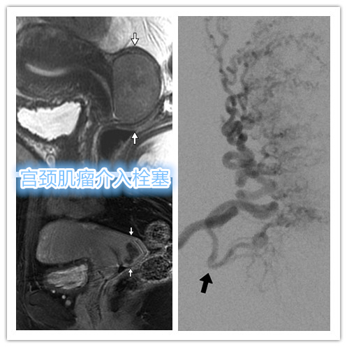 子宫肌瘤的位置、大小对介入栓塞疗效有何影响？