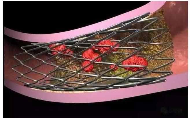 支架内再狭窄怎么治疗最好,支架内再狭窄的治疗动画