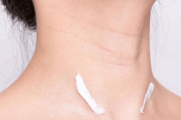 颈纹又深又多怎么治疗,颈纹太深怎么去颈纹