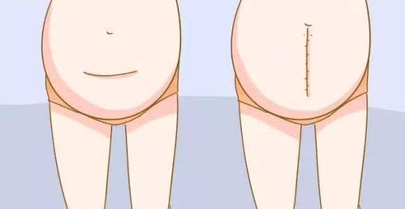 剖腹产，横竖都是一刀？有区别吗？