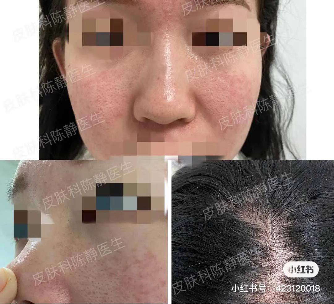 鼻头发红是日光性皮炎还是酒渣鼻,鼻头隐约有点红