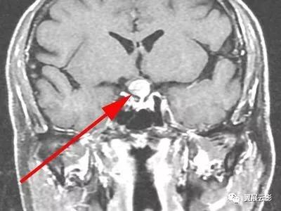 脑部脓肿怎么治疗,多发性脑脓肿能自愈吗