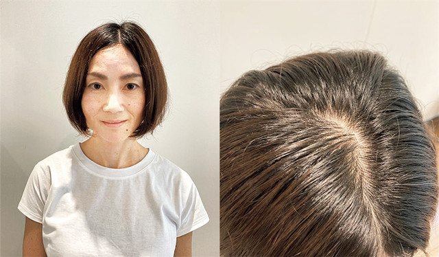 40岁女人头顶脱发严重怎么办,女人头顶有旋头发很少怎么处理