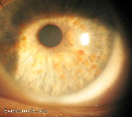 全身内外都是瘤子是什么病,全身长满瘤子怎么治疗