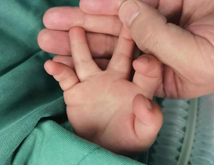 并指畸形免植皮案例,并指畸形